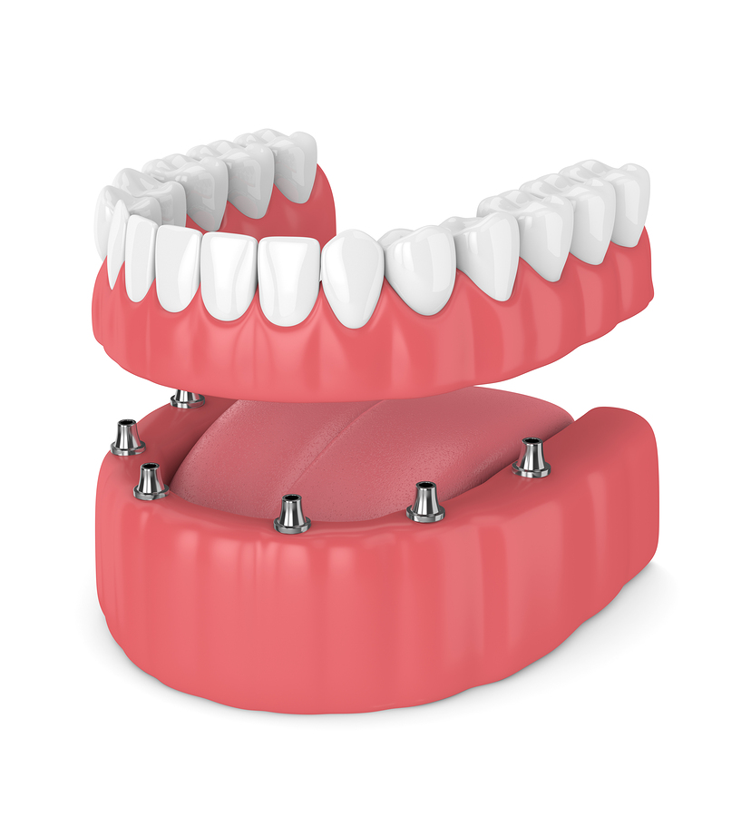 Prothèse dentaire amovible sur implants – Centre dentaire Ruel à Chambly Prothèse dentaire amovible sur implants - Centre dentaire Ruel à Chambly