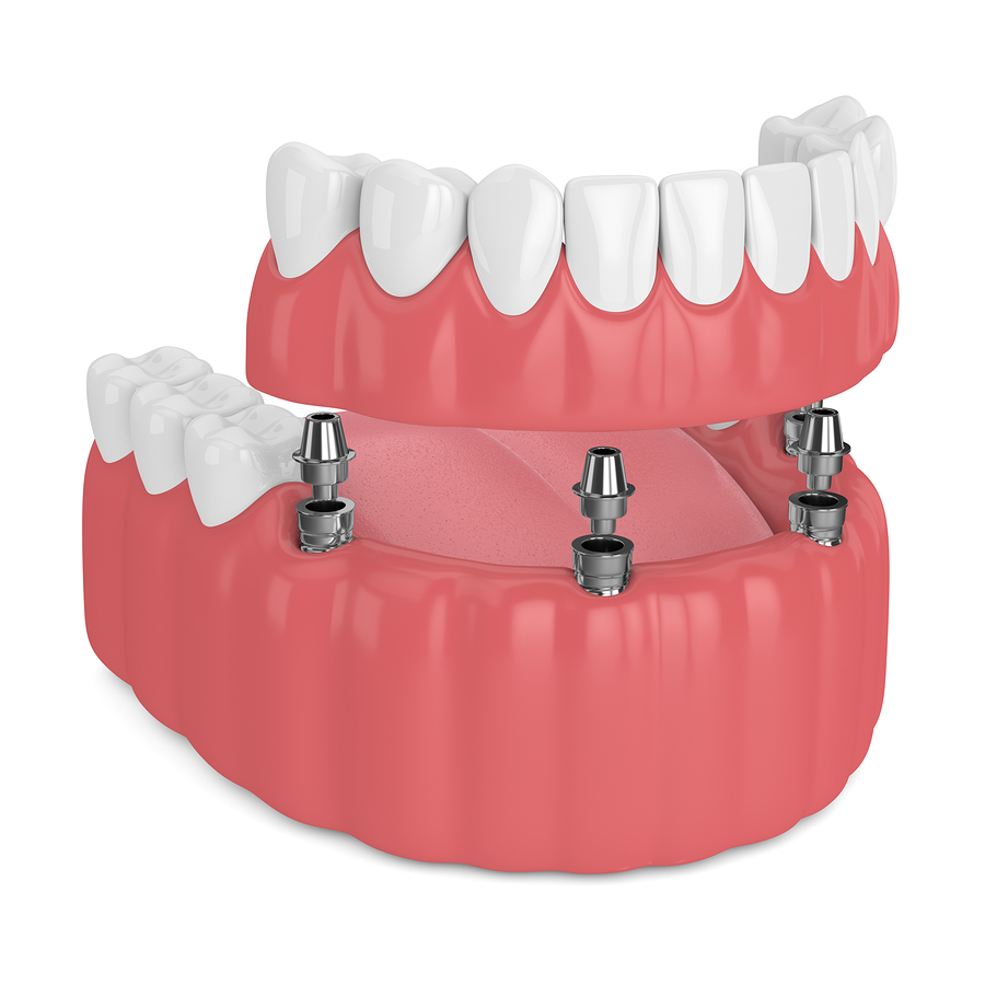 Prothèse dentaire sur barre sur implants – Centre dentaire Ruel à Chambly Prothèse dentaire sur barre sur implants - Centre dentaire Ruel à Chambly