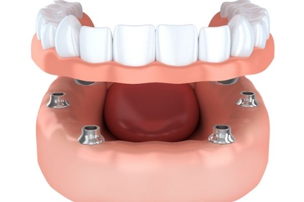 Denturologie – Prothese sur implants – Centre dentaire Ruel a Chambly Denturologie - Prothese sur implants - Centre dentaire Ruel a Chambly